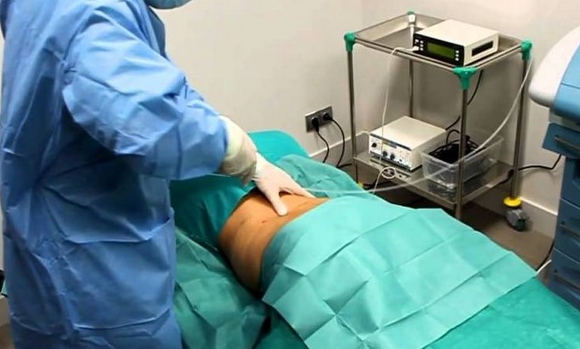 Lipocirugia